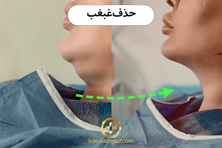 لیپو ساکشن موضعی